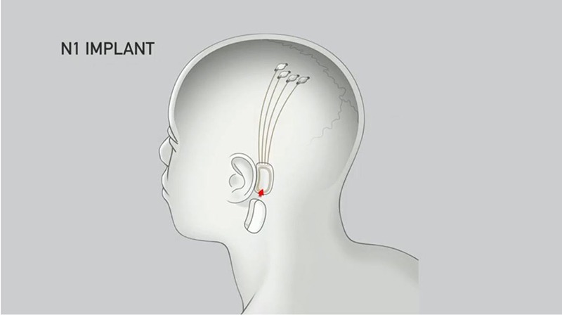 Implante Bci Neuralink